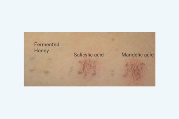 Mật ong lên men lại không gây kích ứng hay mẩn đỏ với da