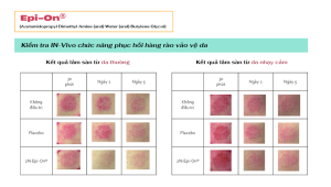 Epi-On: Phục hồi hàng rào bảo vệ da
